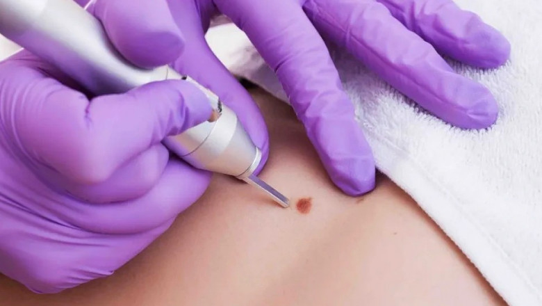 Is Skin Wart Removal Expensive?