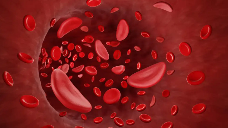 Sickle Cell Disease Treatment Market Growth and Forecast Report