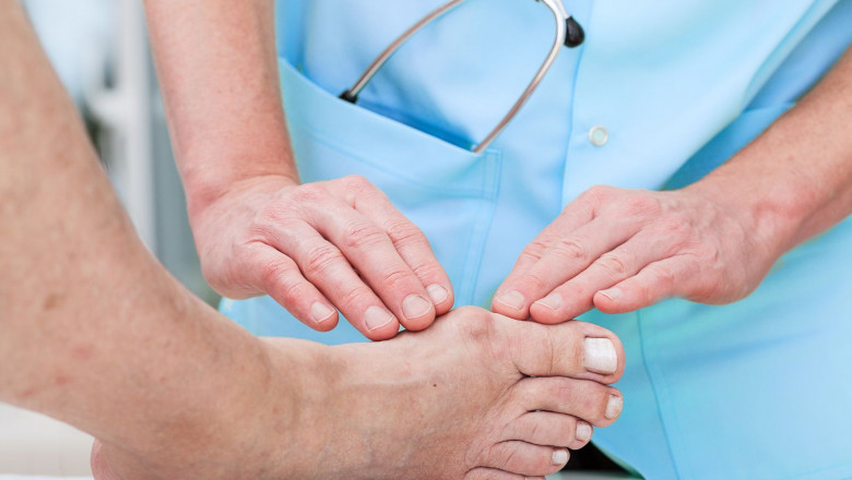 Treatment for Bunions - Philadelphia Holistic Clinic - Dr. Tsan & Associates