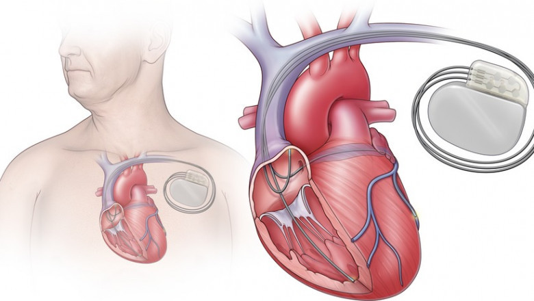 A New Era in Heart Failure Management: Market Dynamics of Cardiac Resynchronization Therapy