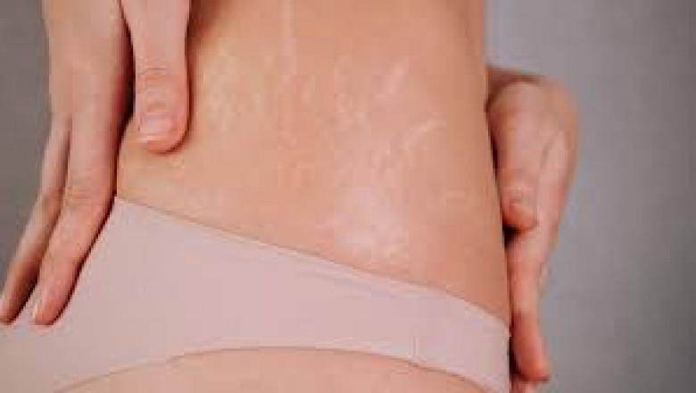 Are Stretch Mark Treatments Painful?