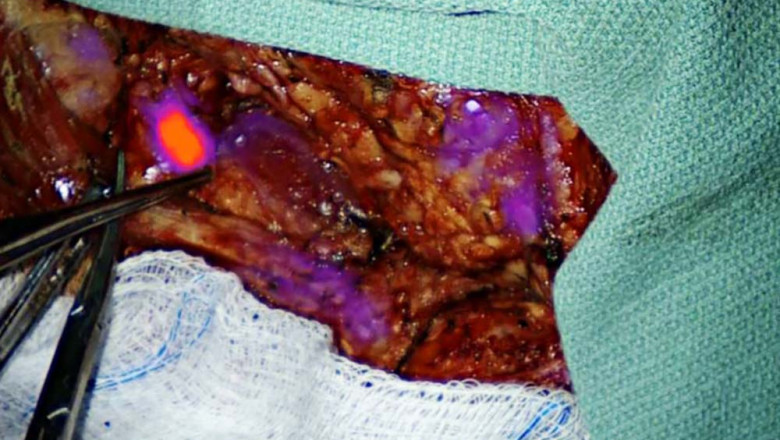 Fluorescence Guided Surgery System Market Size, Share, Forecast Report | 2025-2033 | Reports and Insights