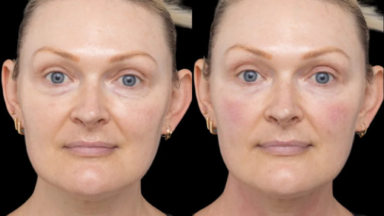 The Under Eye Fillers Over Surgery at the Best Plastic Surgeons in Dubai
