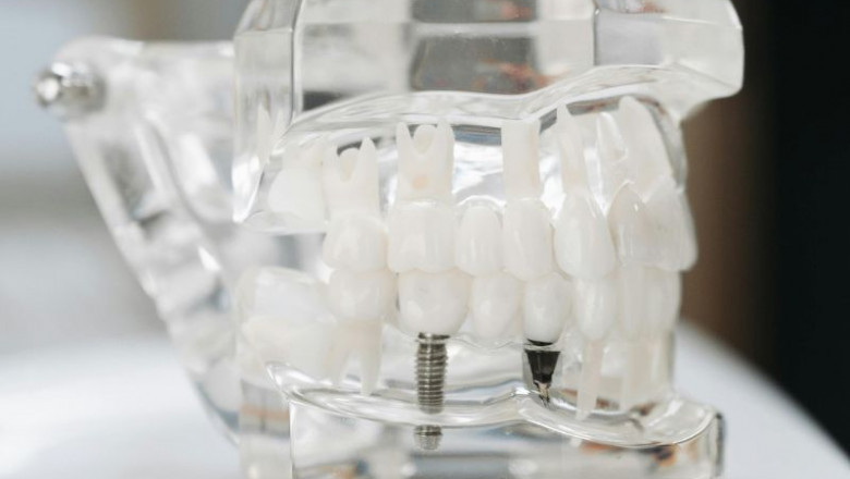 United States Dental Implants Market Report 2032