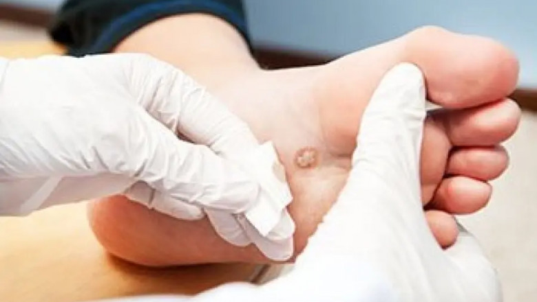 How Long Does Skin Tag Removal Take