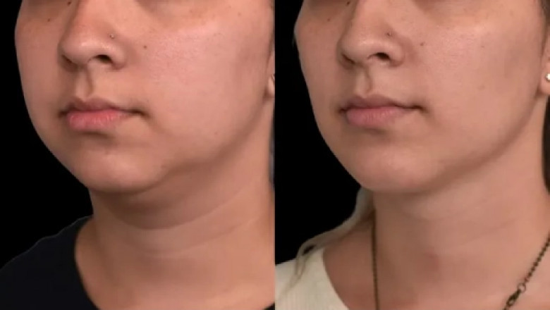 The History and Evolution of Double chin removal in Dubai Procedures
