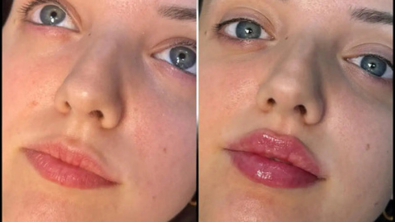 Achieve Natural Lip Volume with Fillers Treatment in Dubai