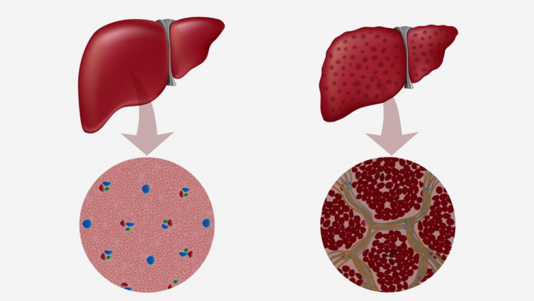 ACLF Market to Grow Rapidly with Cellular Therapies