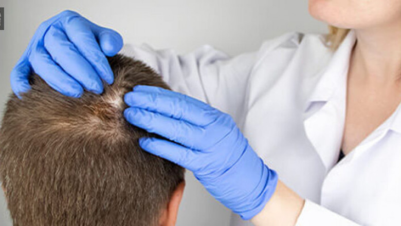 Alopecia Areata Treatment Market to Soar on JAK Inhibitor Adoption