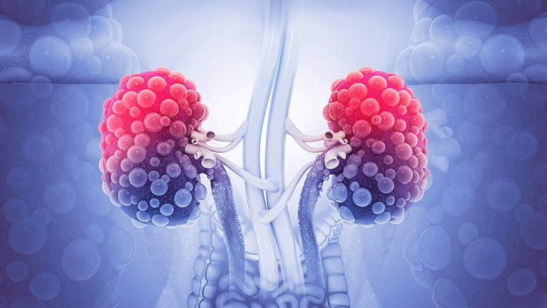 Autosomal Dominant Polycystic Kidney Disease Market is Anticipated to Witness High Growth Owing to Novel Therapeutics