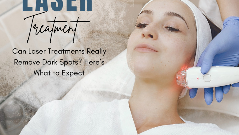 Can Laser Treatments Really Remove Dark Spots? Here’s What to Expect