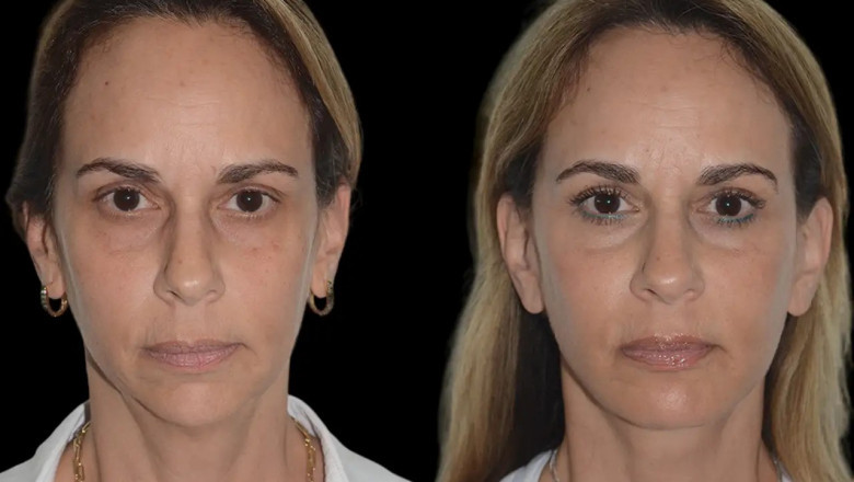 Choosing the Right Practitioner for Chin Fillers Treatment in Dubai