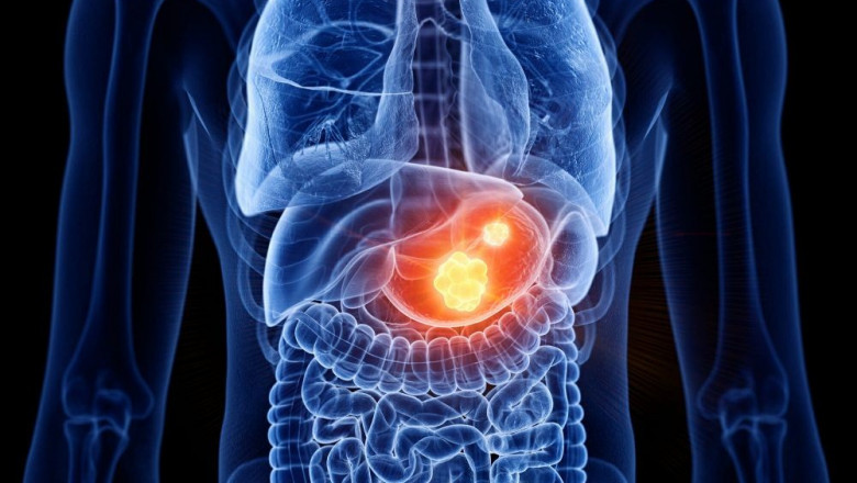 Gastrointestinal Stromal Tumor (GIST) Market Growth Fueled by Targeted Therapies