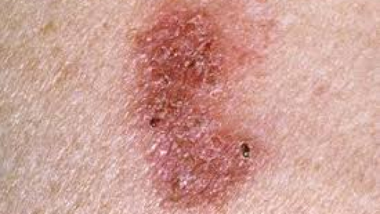Global Bowen’s Disease Treatment Market Size, Forecast 2023 - 2033