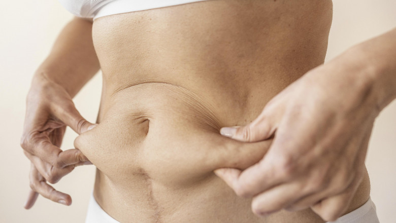 Preparing for the Unexpected Tackling Liposuction Challenges in Dubai