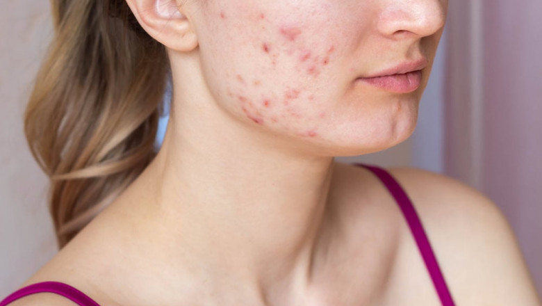 Say Goodbye to Breakouts with This Proven Acne Treatment Plan