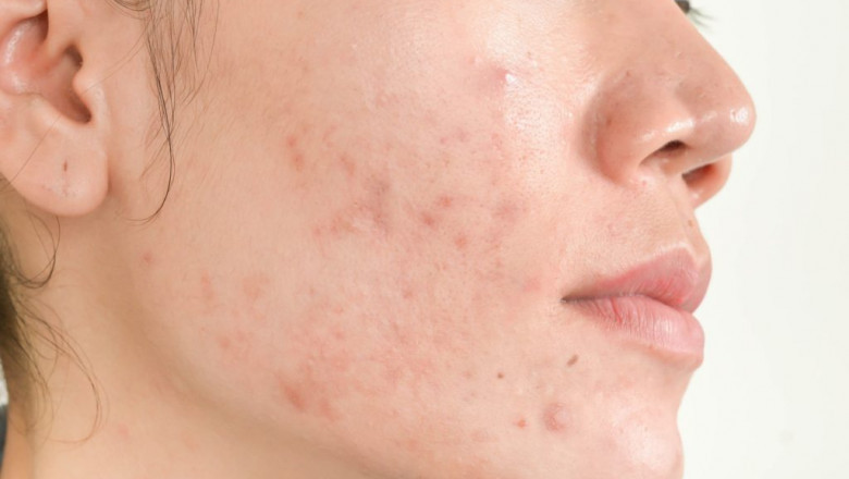Understanding and Managing Adult Acne: A Comprehensive Guide