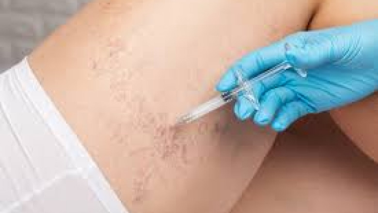 Are Laser Treatments Effective for Varicose Veins?