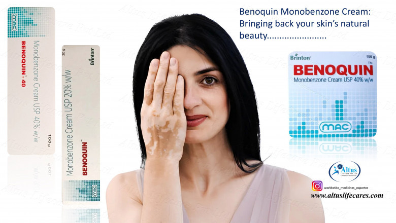 Benoquin Cream's Remarkable Journey in Vitiligo Therapy