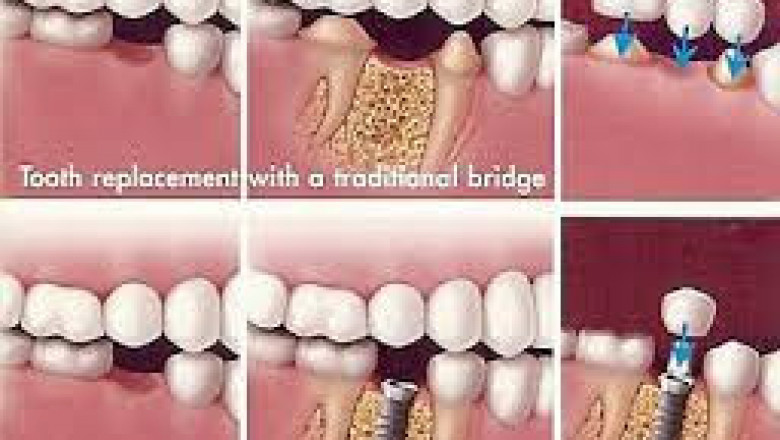 Dental Bridge vs Implant: Which Tooth Replacement Option Is Right for You?