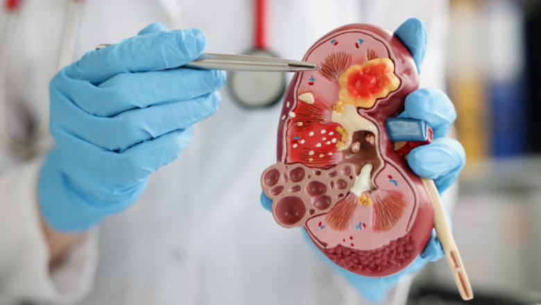 Diabetic Kidney Disease Market to Benefit from SGLT2 Inhibitors