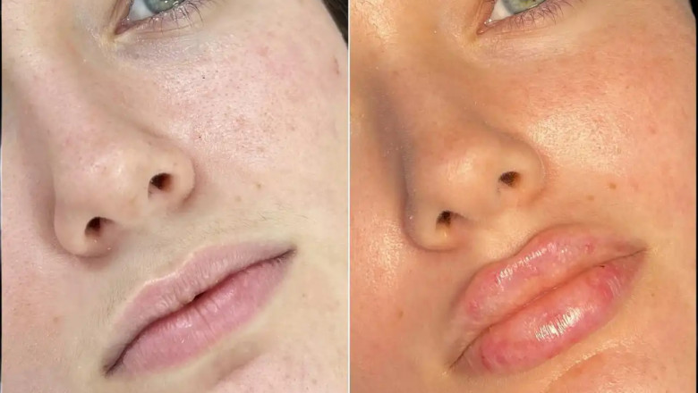 Enhancing Facial Features with Fillers Treatments in Dubai