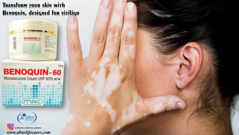 Experts Reveal the Truth About Benoquin 60% Cream and Vitiligo Treatment