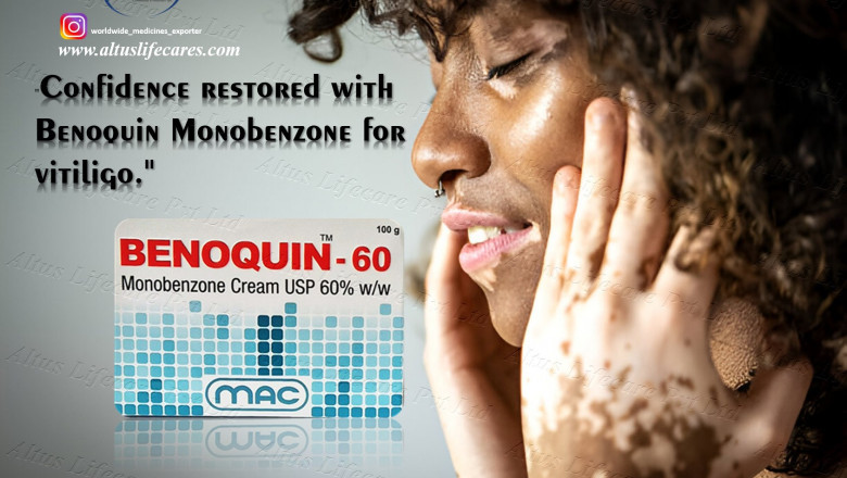 He Tried Benoquin Monobenzone 60% for Vitiligo – You’ll Never Guess What Happened Next!