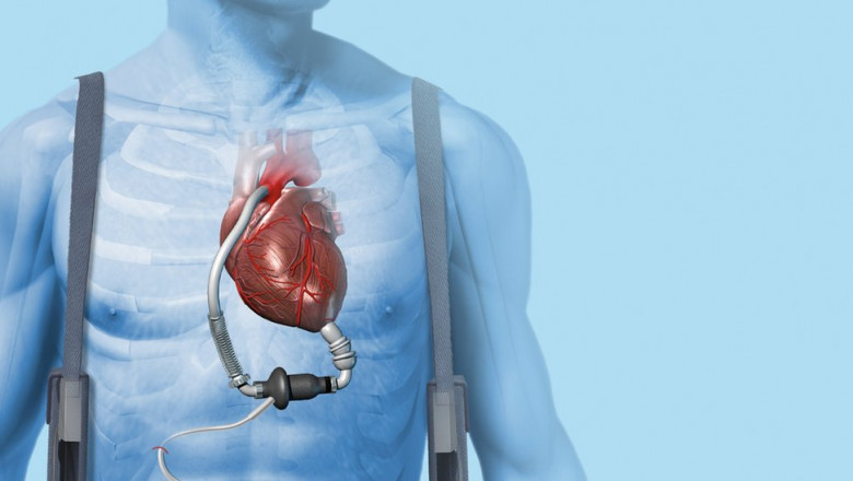Heart Pump Device Market Expected to Soar Owing to Rising Prevalence of Heart Failure