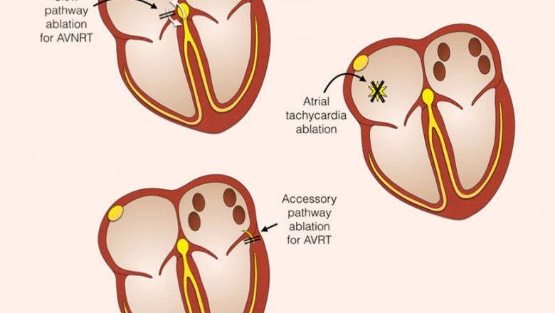 How Do I Choose the Right Cardiologist for SVT Ablation in Abu Dhabi?