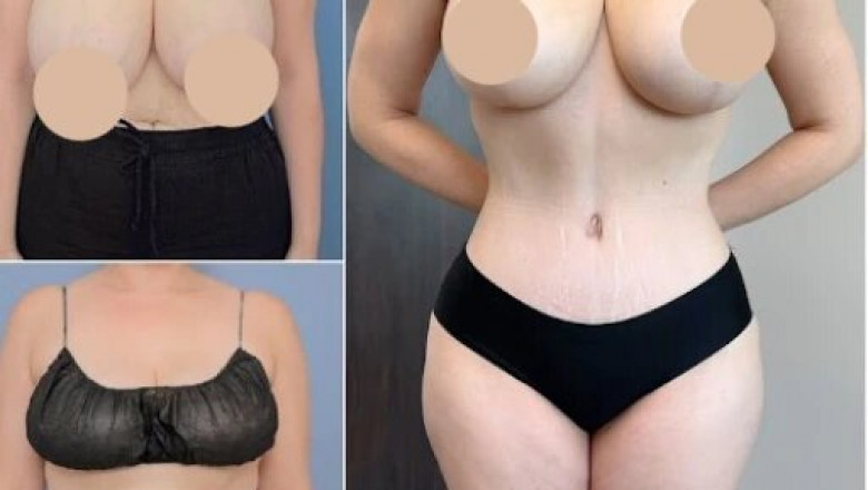 How Tummy Tuck Surgery in dubai Helps Achieve a Flatter Stomach