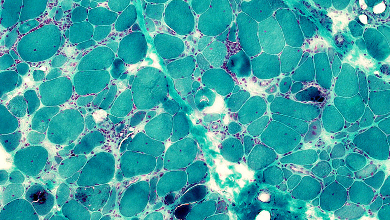 Inclusion Body Myositis Market Growth Driven by Aging Population