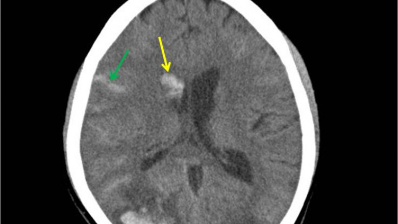 Intracranial Hemorrhage Diagnosis Market to Surge Via AI Imaging