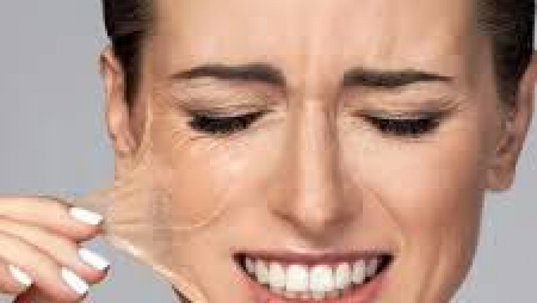 Invest in Your Glow: How Chemical Peels Deliver Real Results