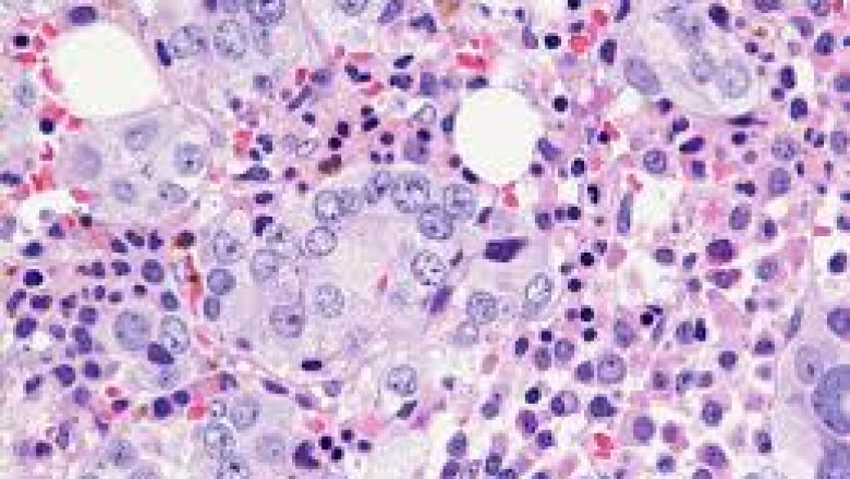 Metastatic Prostate Cancer Market to Surge Owing to Targeted Therapy Advances