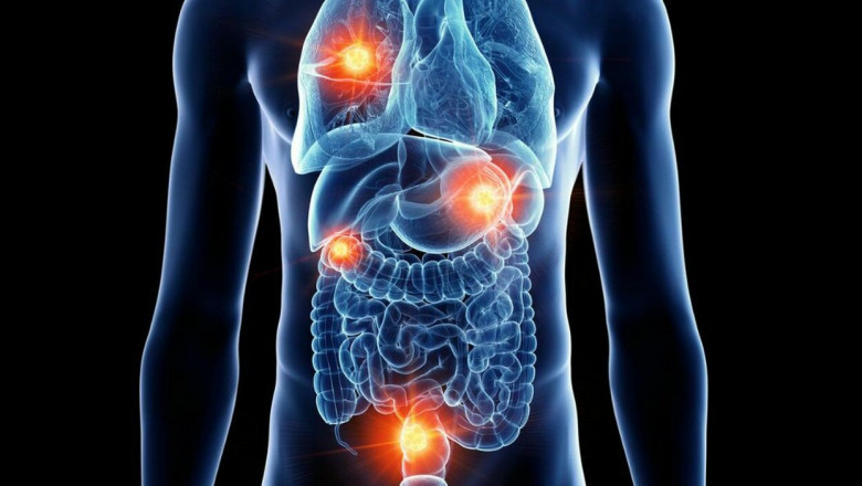 Neuroendocrine Tumors Market to Expand With Innovative Therapies