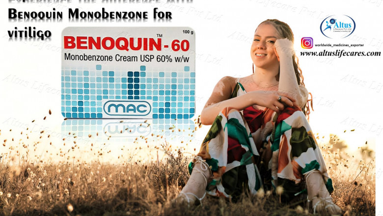One Cream, One Cure? What Benoquin Monobenzone 60 Cream Is Doing for People with Vitiligo