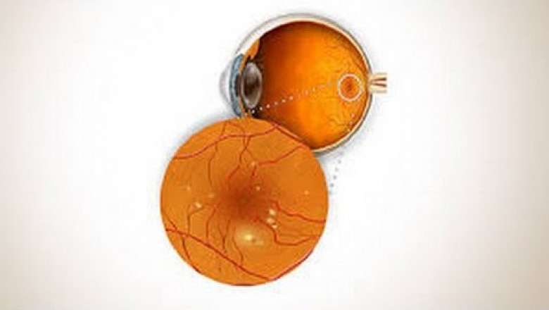 Proliferative Diabetic Retinopathy Market to Soar with Novel Anti-VEGF Therapies