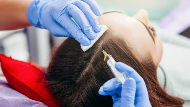 PRP Hair Treatment: Step-by-Step