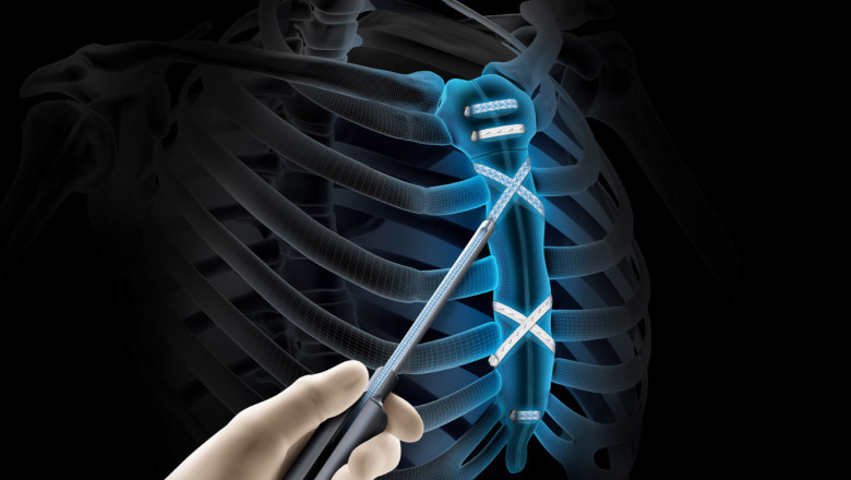 Sternal Closure Systems Market Size Data Analysis To 2033