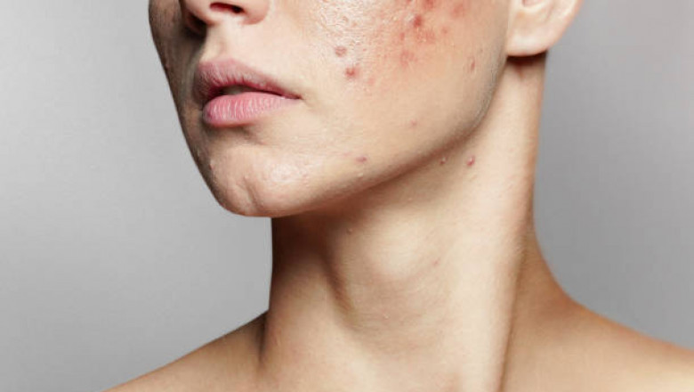 The Rising Demand for Natural and Herbal Acne Treatments in Taiwan: A Deep Dive into the Taiwan Professional Acne Medication Market