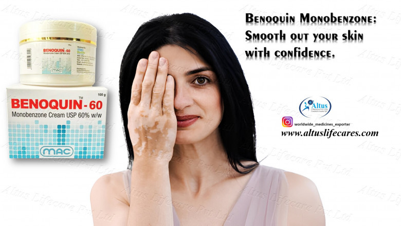 This Cream for Vitiligo Is Going Viral – Is Benoquin 60% Cream the Ultimate Solution?