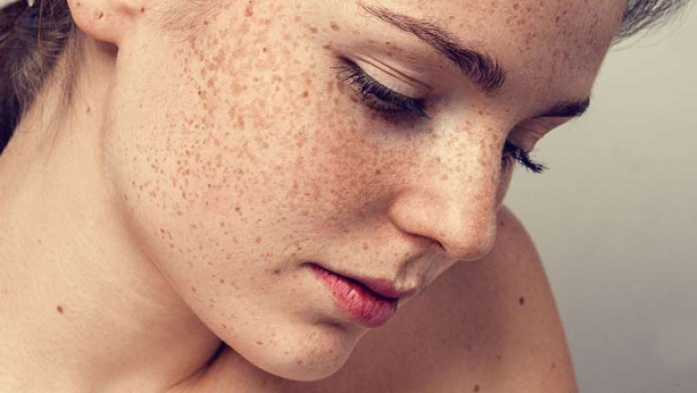 Understanding Melasma: Causes, Symptoms, and Treatments