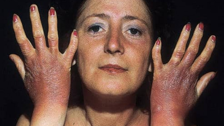 Acute Intermittent Porphyria Market is Anticipated to Witness High Growth Owing to Novel Therapeutics