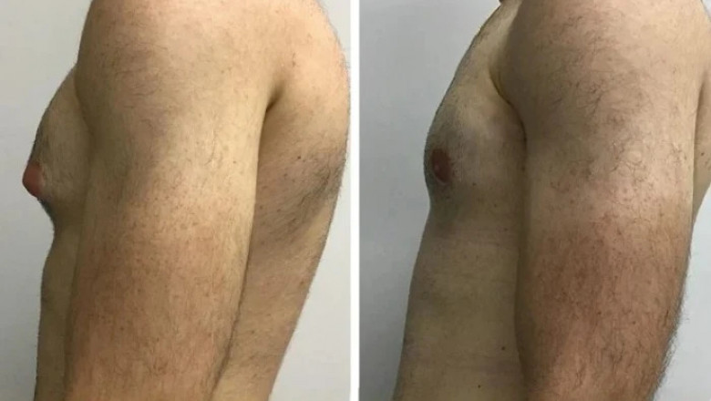 Best Gynecomastia Surgeon in dubai: Leaders in Safe Male Breast Surgery
