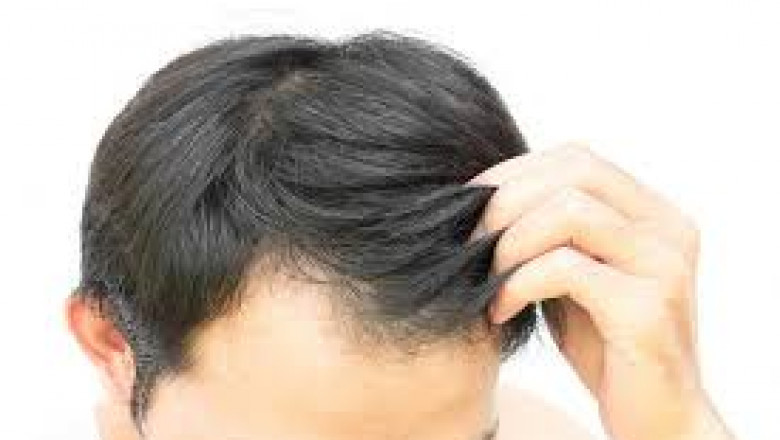 Best Natural Remedies for Healthier, Fuller Hair Without Medication