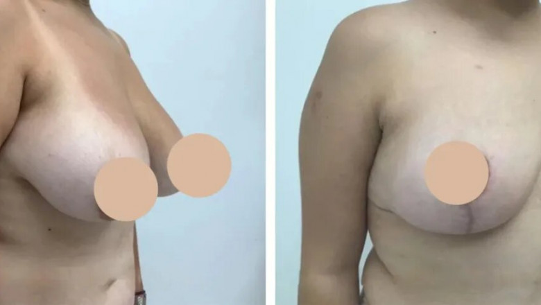 Discover the Best Breast Reduction Surgeon in dubai for a Life-Changing Procedure