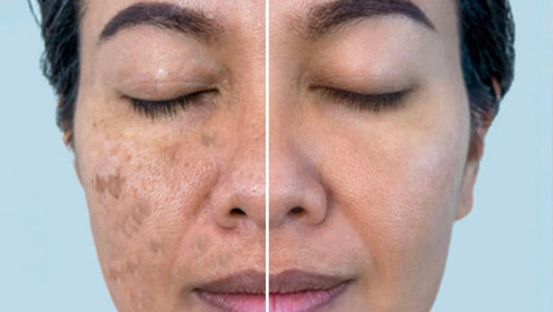 Expert Advice: Selecting the Right Female Dermatologist for Your Skin Needs