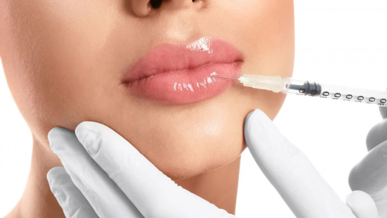 Lip Fillers Dubai: The Recovery Process and What You Need to Know After Lip Filler Treatment
