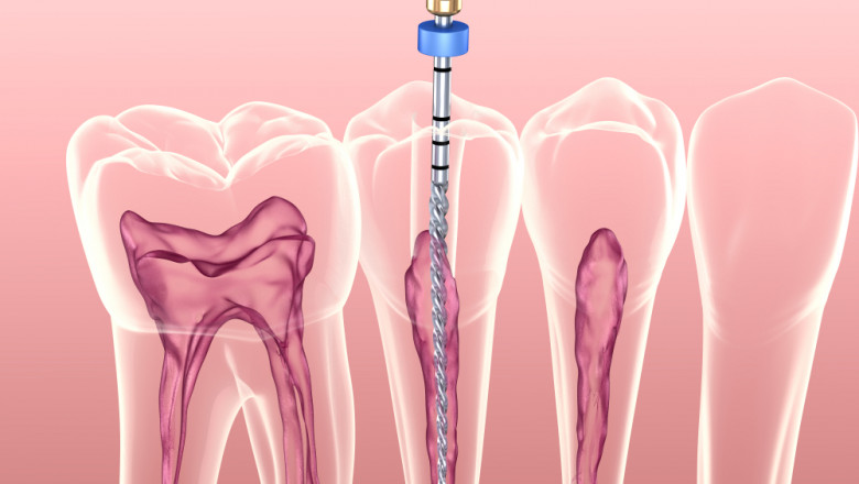 Root Canal for Deep Cavities in Dubai: Everything You Need to Know